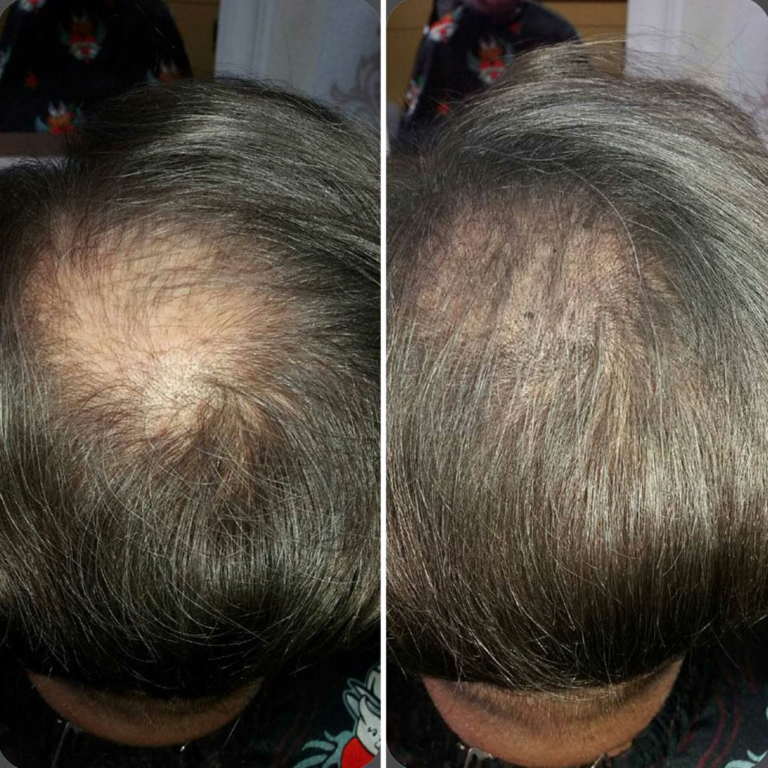 Before and after pictures of hair therapy